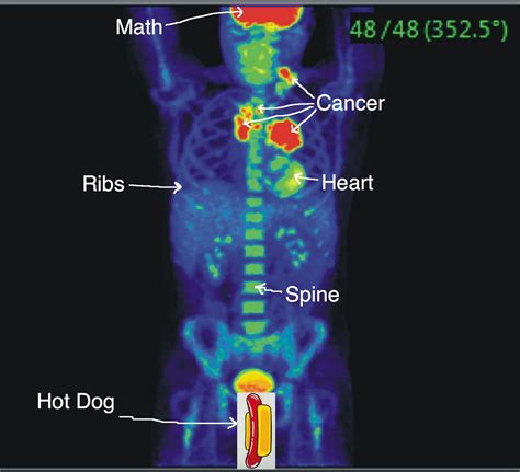 how to read pet scan results